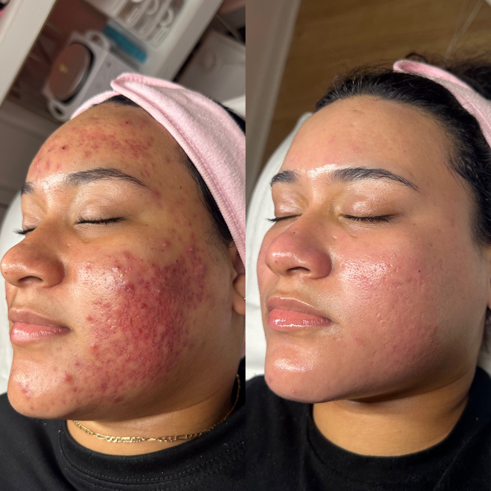 Acne Bootcamp Consult -consult only at Amber The Skin Fairy in Sevierville, TN