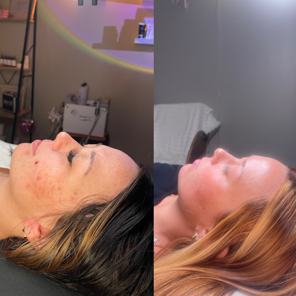 Face Reality Acne Consult/Treatment