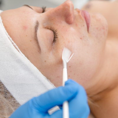 Brightening Chemical Peel