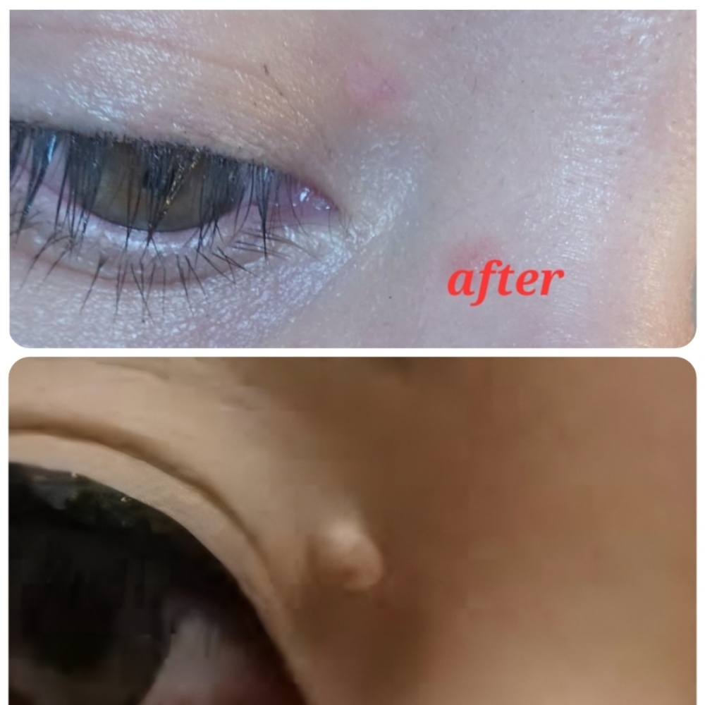 Skin Tag/ Mole Removal at PURE ELEGANCE in Lubbock, TX