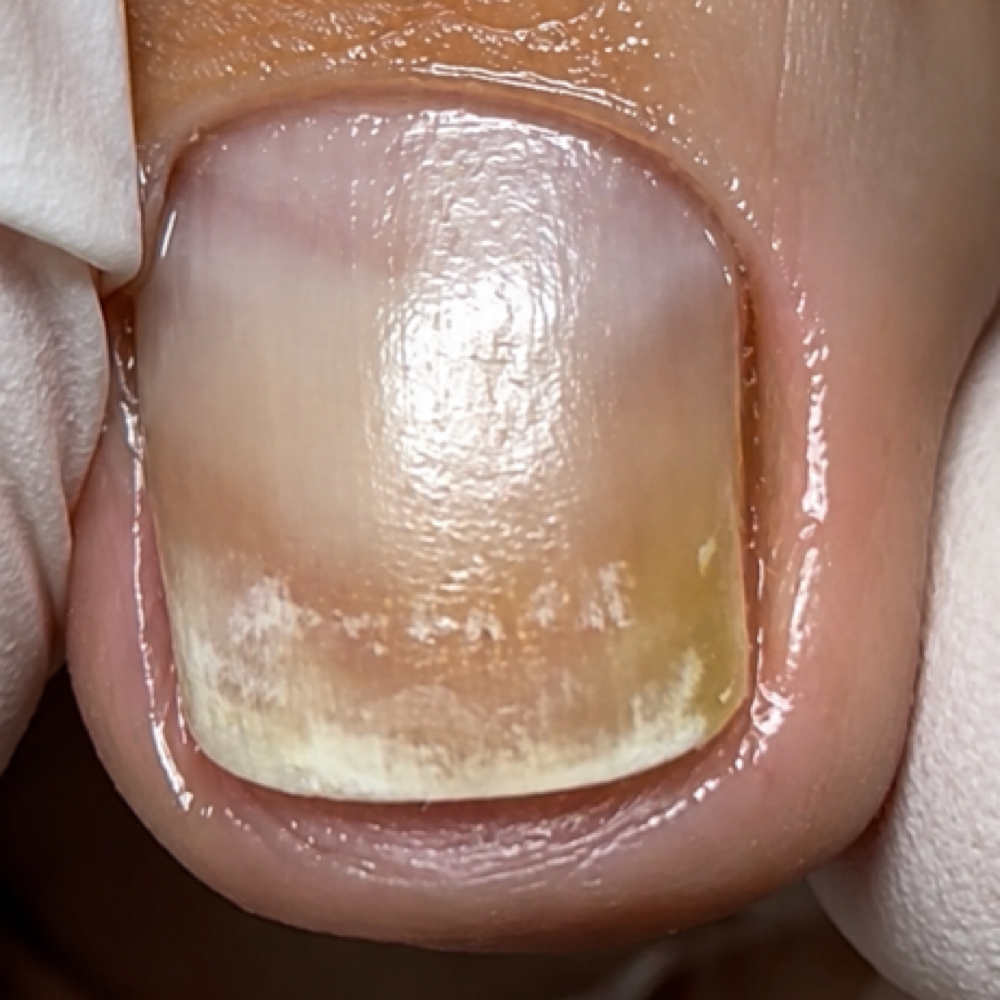 Involuted/ingrown nail mitigation at Nail Haus SRQ in Sarasota, FL