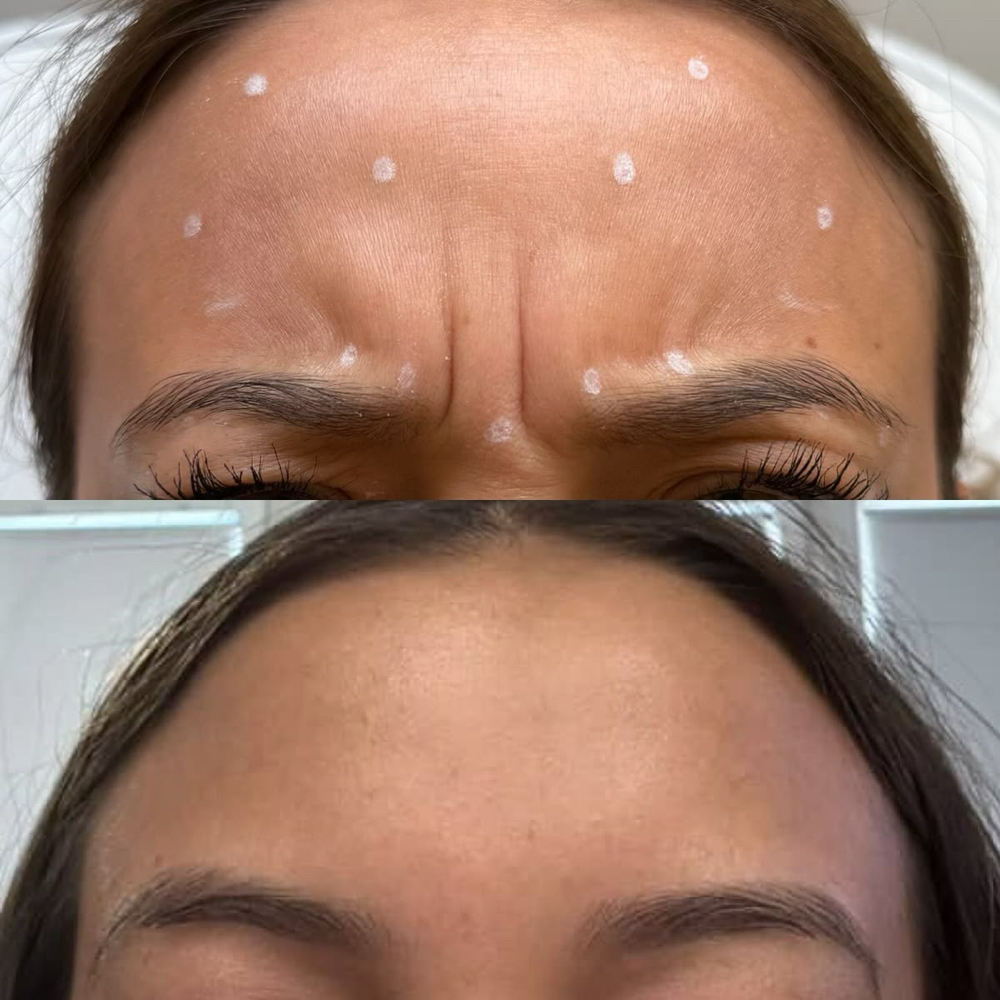 Botox for Frown Lines / 11 Lines at La Belle Aesthetics & Wellness in Hellertown, PA