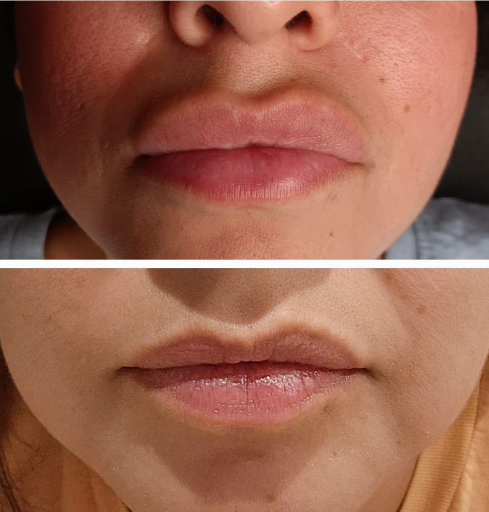 Lip Filler Dissolver