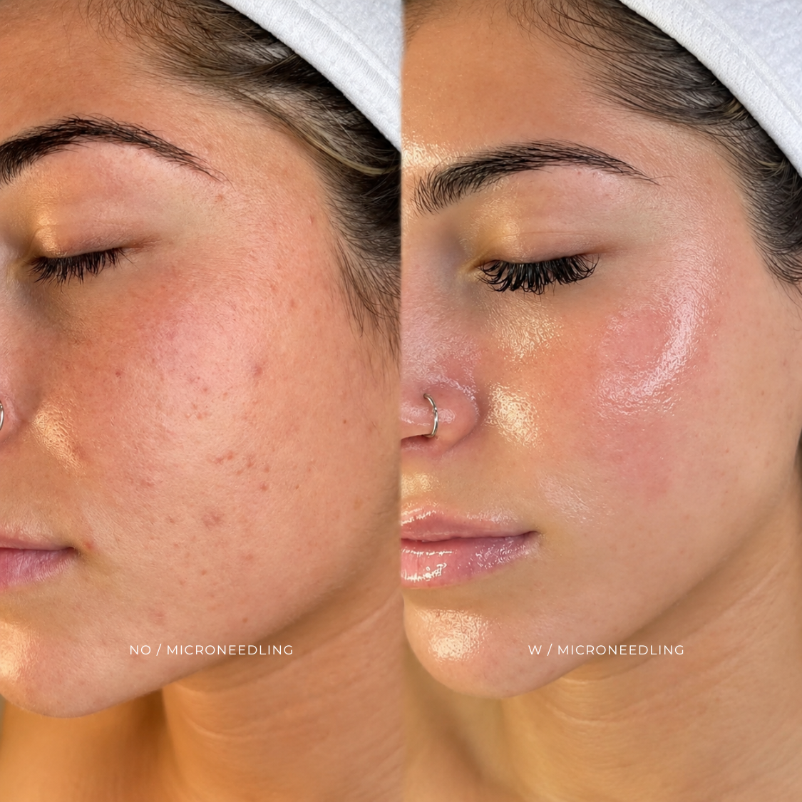 PIEL |  MICRONEEDLING + PRP at EROXSPA in Houston, TX