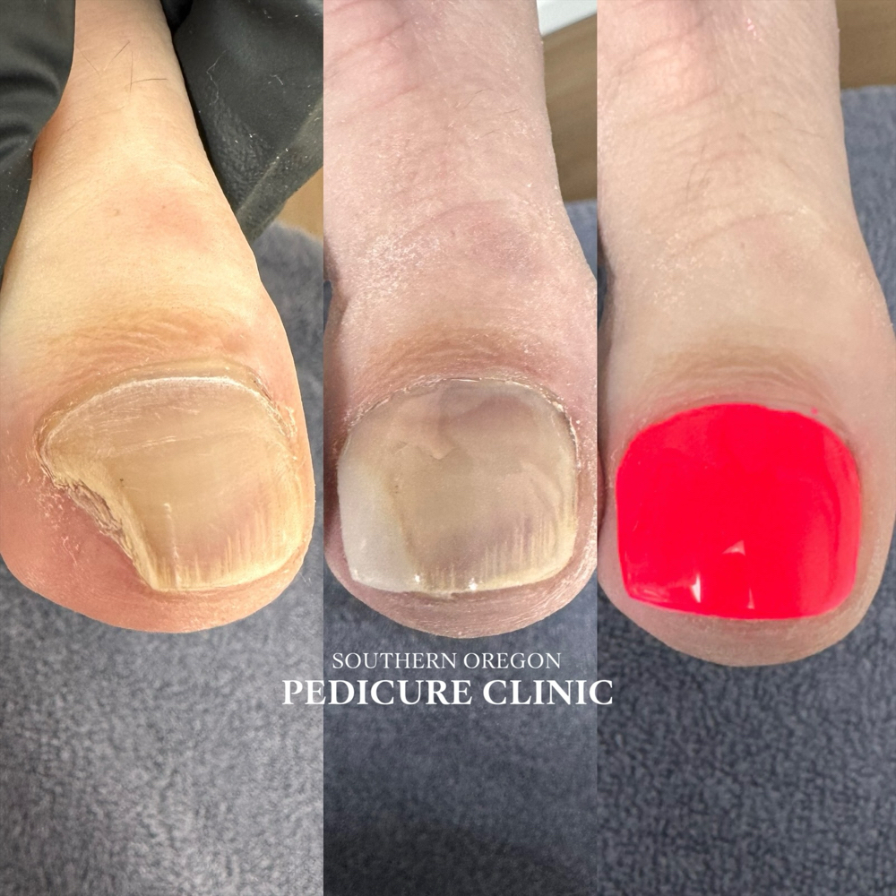 ToeNail Reconstruction SMALL at Southern Oregon PEDICURE CLINIC in Medford, OR