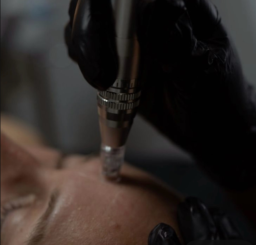 Dry Microneedling