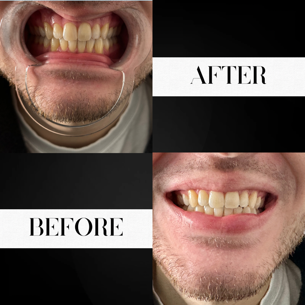 30 Minute Whitening Session