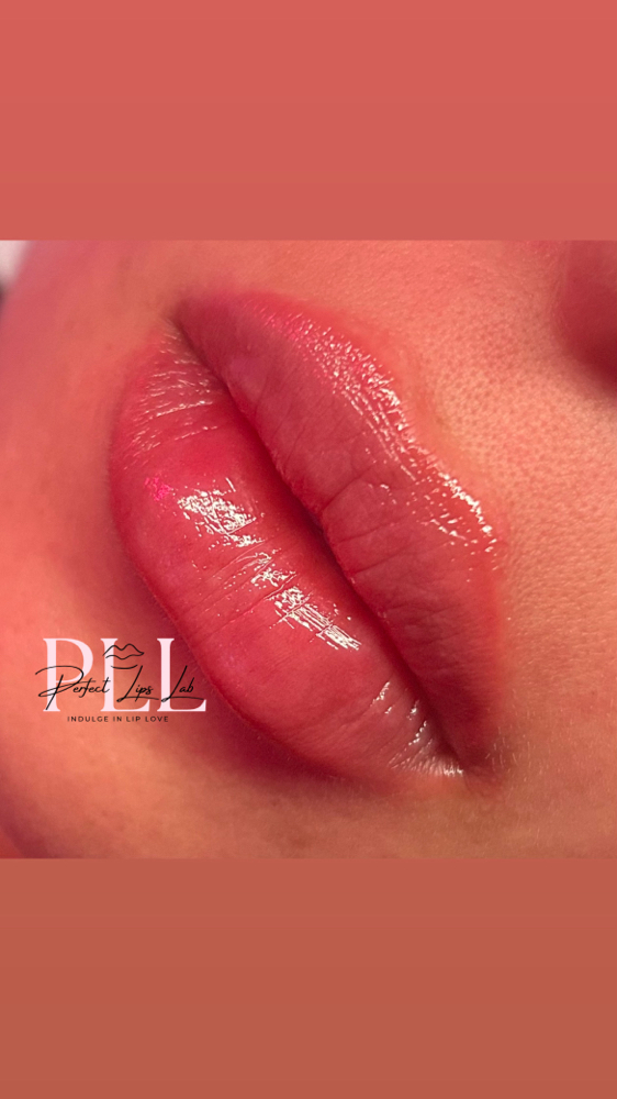 1.5 ML Juvederm / Restylane