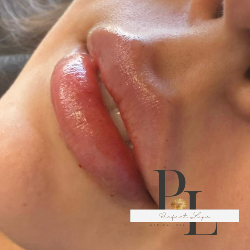 1.5 ML Juvederm / Restylane