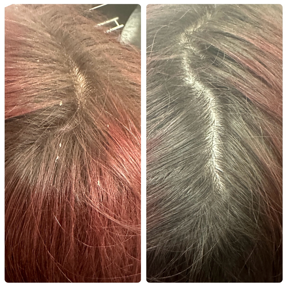 Exfoliating Scalp Treatment
