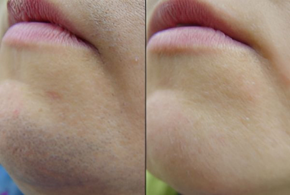 Chin Wax