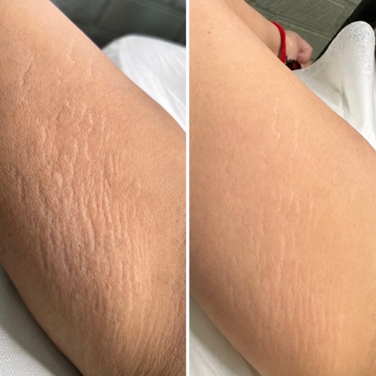 Stretch Mark Revision at Studio PrimaVera in Roswell, GA