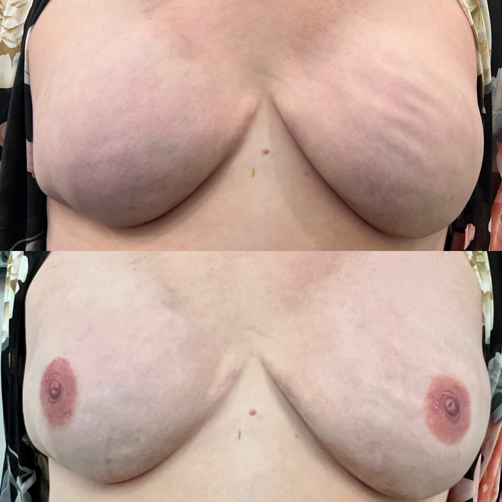 3D Areola Reconstruction -bilateral