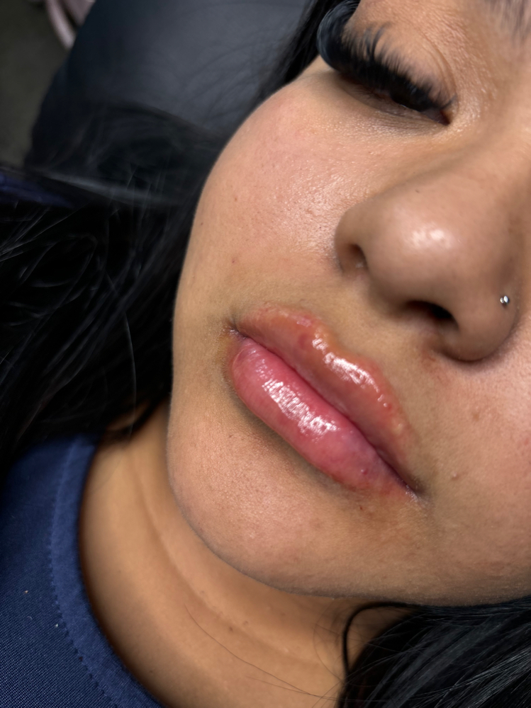 Micro Needle 0.5ml
