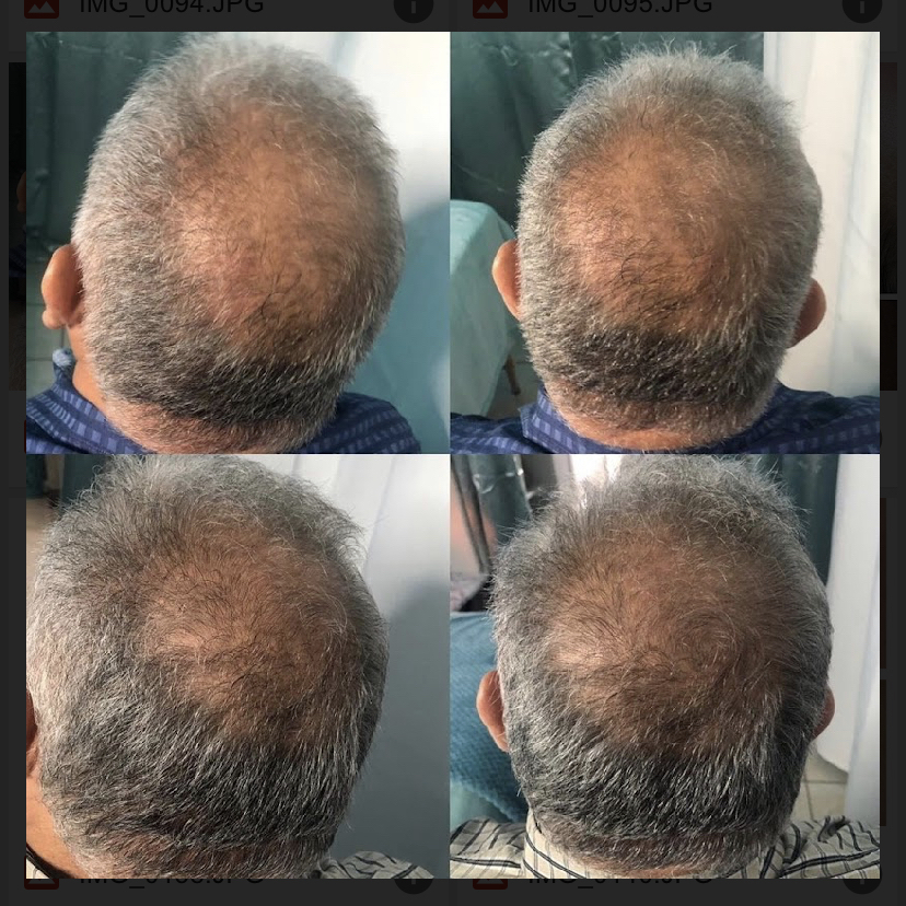 Hair Regrowth Package Of Six