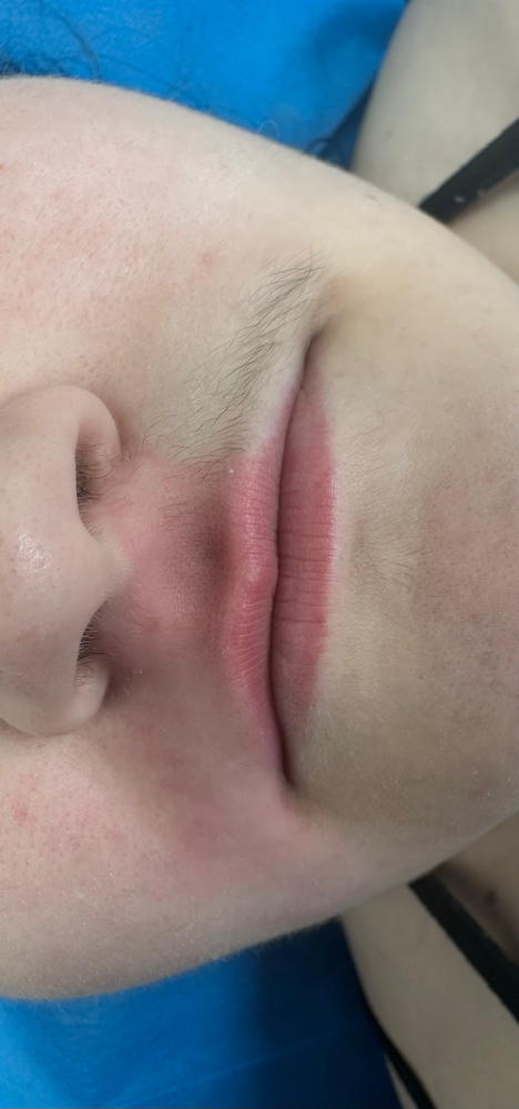 Upper Lip