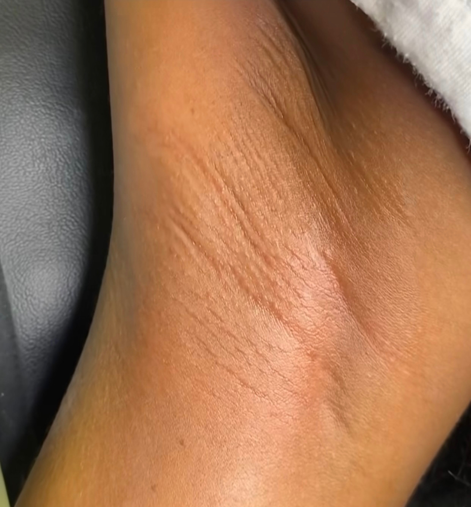Underarm