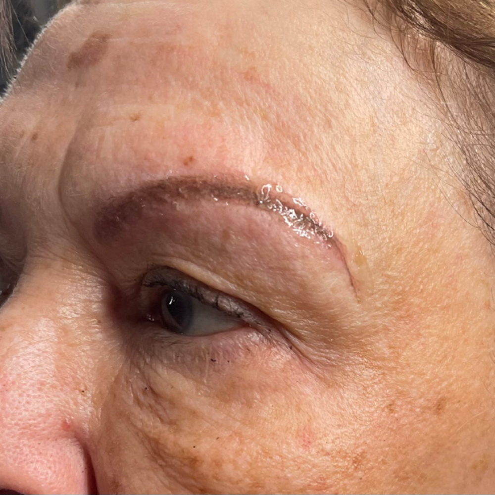Brow Correction at Elevate in Polson, MT