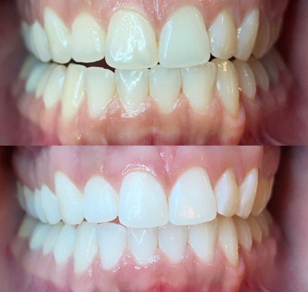 Teeth Whitening