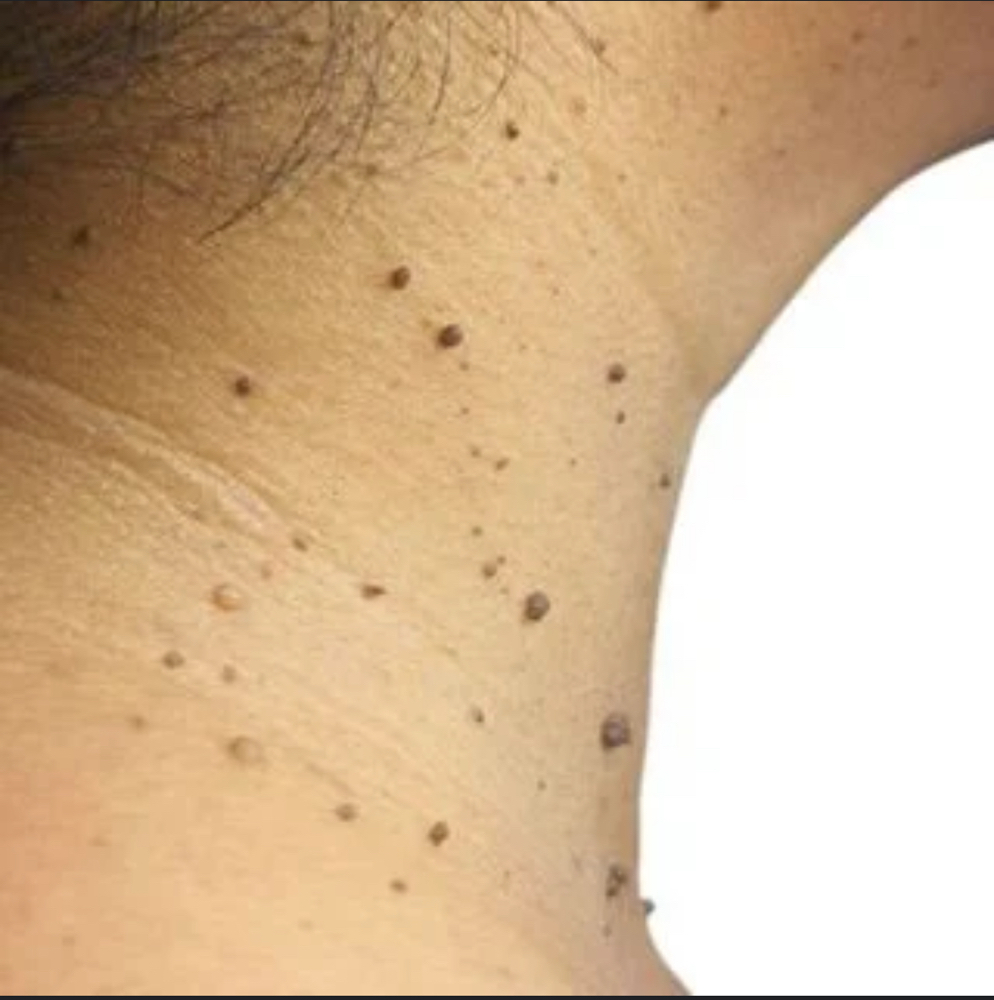 Skin Tag Removal