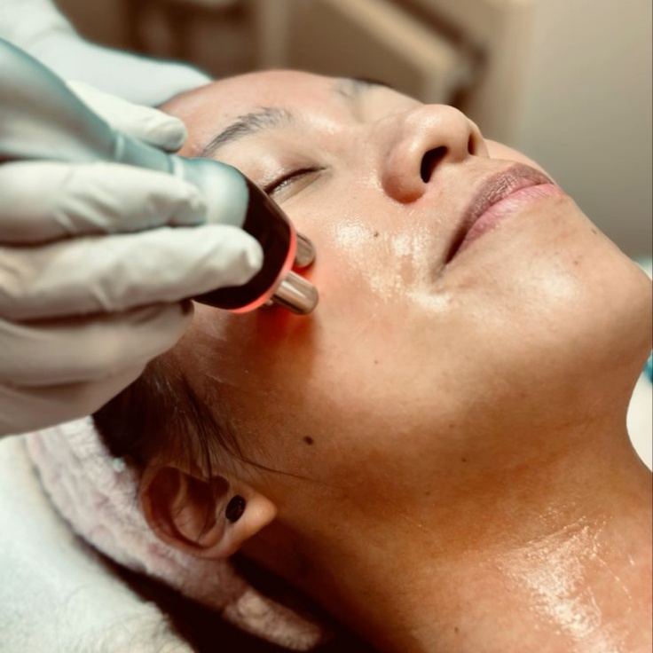 RF Skin Tightening Facial at Wild Rose Med Spa in Chanhassen, MN