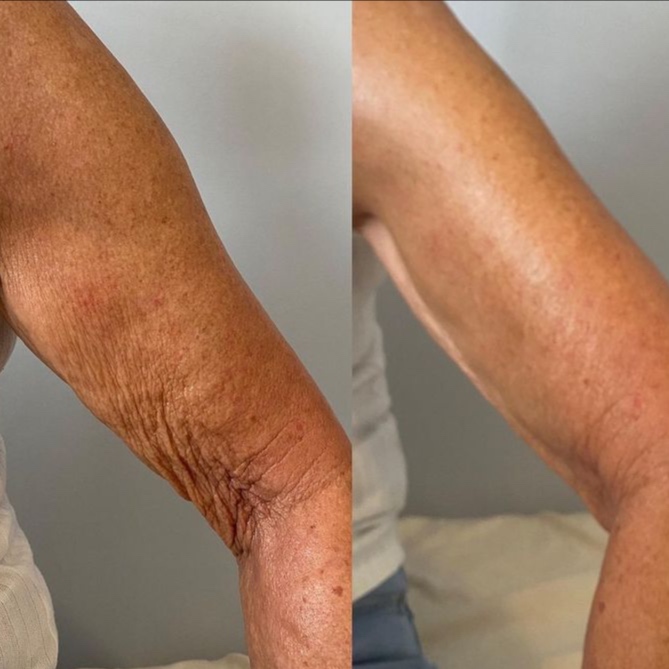 Arm Sculpt & Tightening at lillyrosebeauty in Murrieta, CA