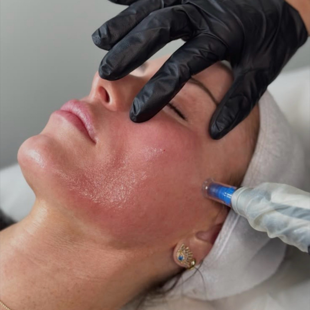 Microneedling at Massaged by Shyrae in Amesbury, MA