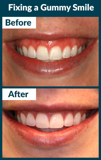 Gummy Smile Treatment