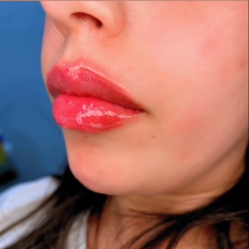 Restylane Kysse ® Filler Syringe at EVERWELL LUXE in Kissimmee, FL