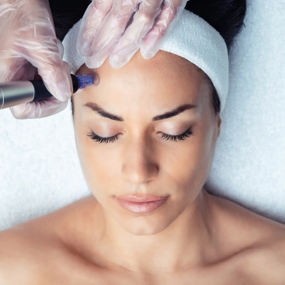 Microchanneling Facial at Majestic Aesthetics by Jaki