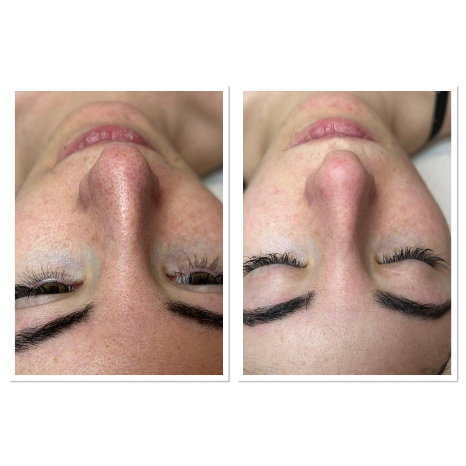 Enzyme Peel