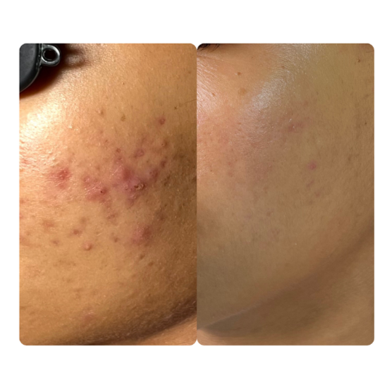 Clear Skyn: Acne Treatments