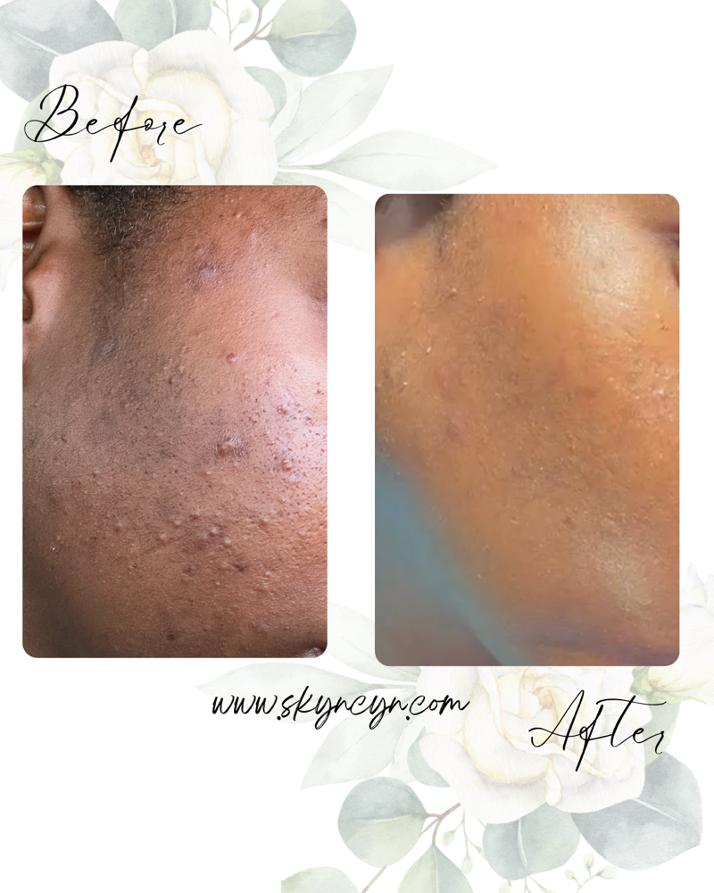 Clear Skyn Club: Acne Program