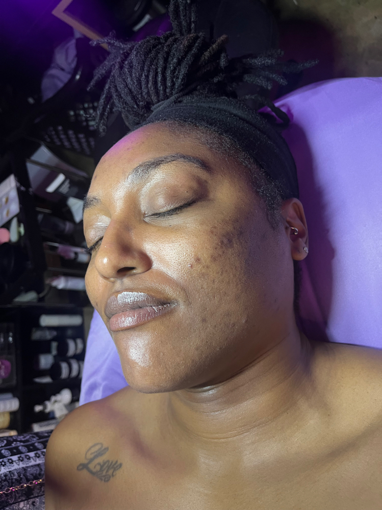 Acne Be Gone! Facial