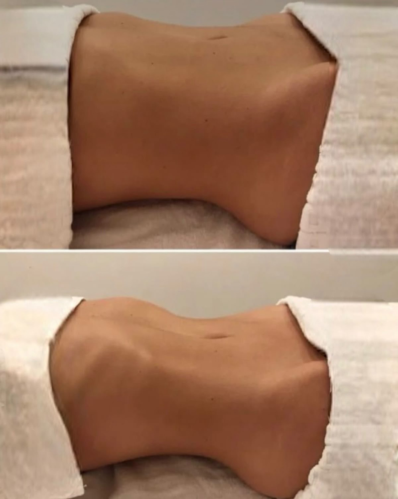 Bridal Body Sculpting 8 Package at GDN in Woodland Hills, CA