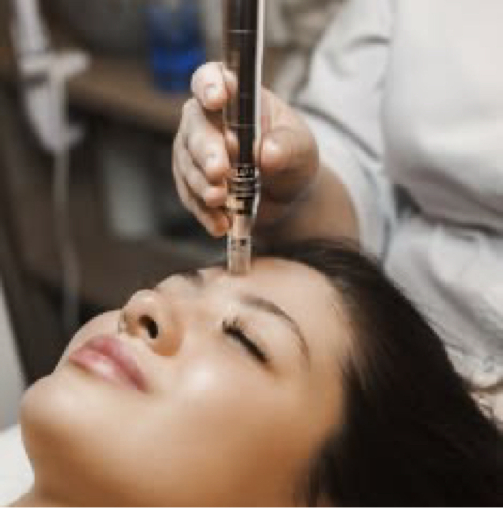 Microneedling Face at Vogetica Beauty Lab (Regina) in Dallas, TX