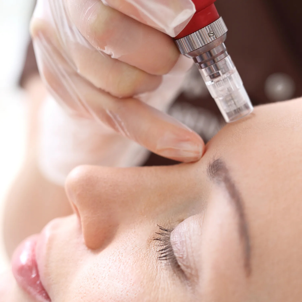 Microneedling Facial at Glam Lab in Rancho Cucamonga, CA