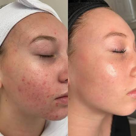 30 Min Teen Acne Treatment at bridgette nichole artistry in Dixon, IL