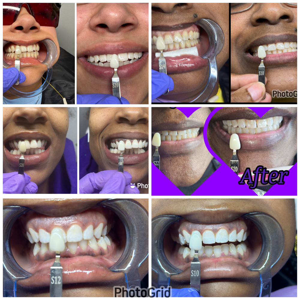 Silver Teeth Whitening