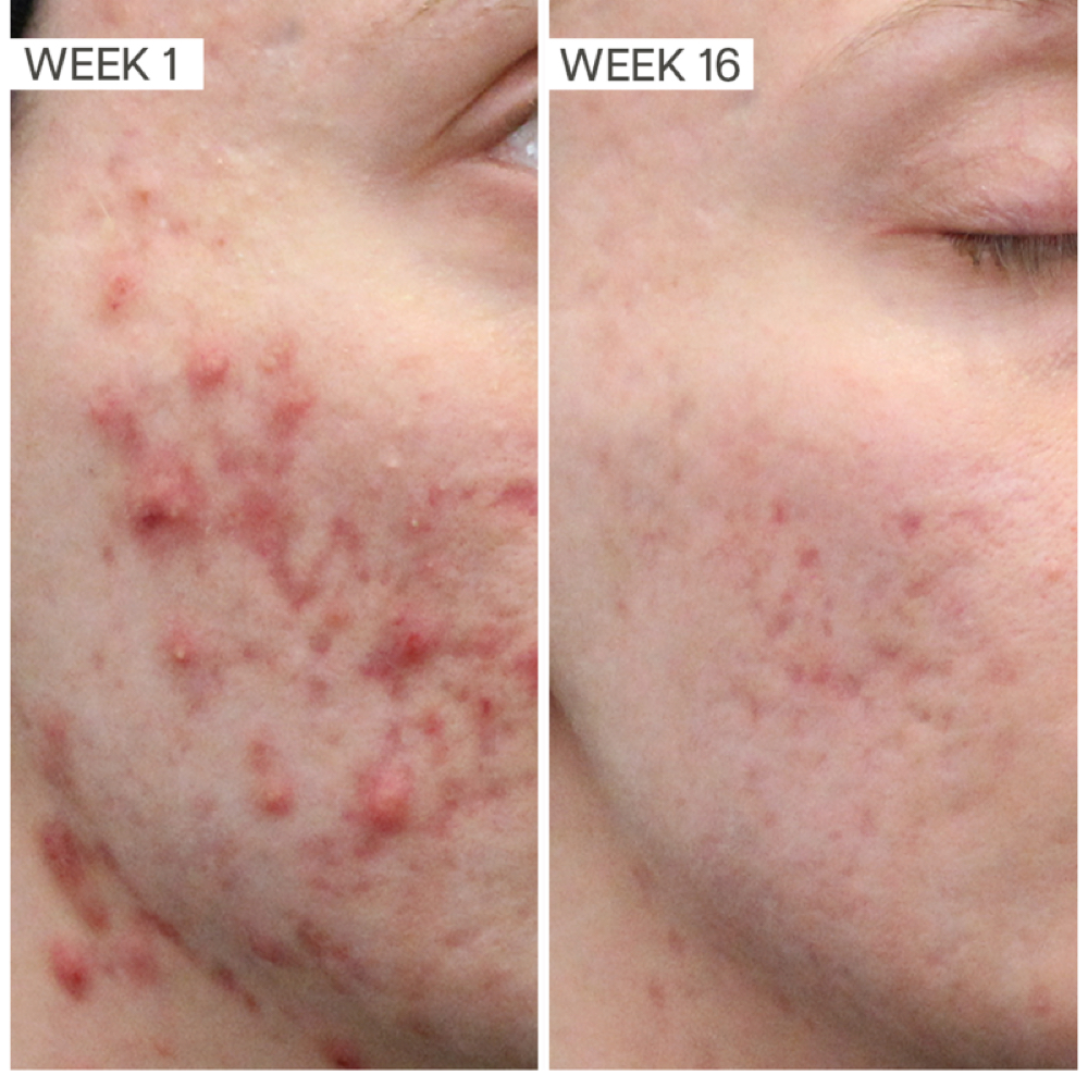 Acne Bootcamp Treatment at Haus of Skin OC in Huntington Beach, CA