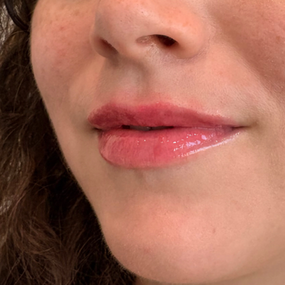Lip Contouring at TRES Aesthetics in Missouri, TX