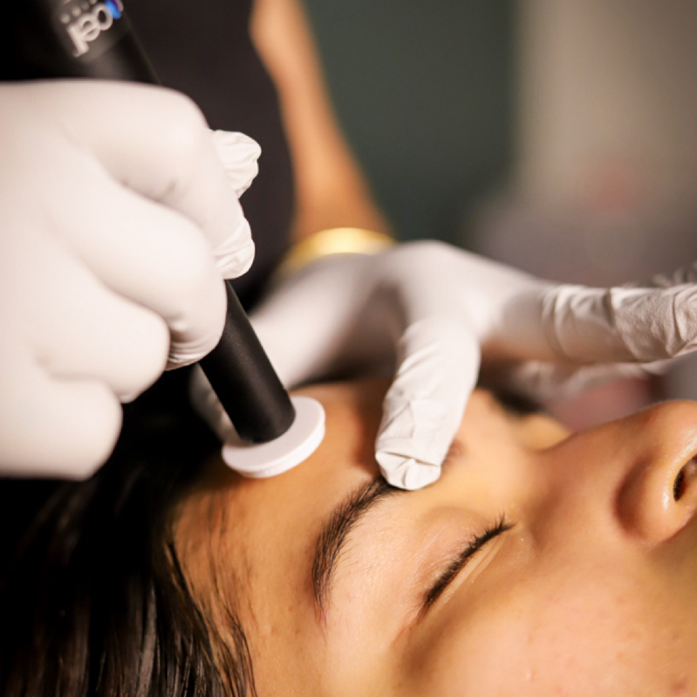 Microcanalización Facial Procell at Pure Canvas Co. in San Jose, CA