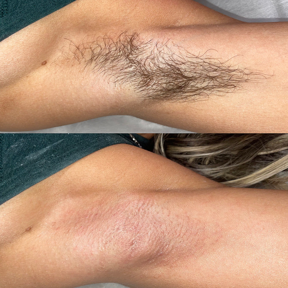 Arm Wax