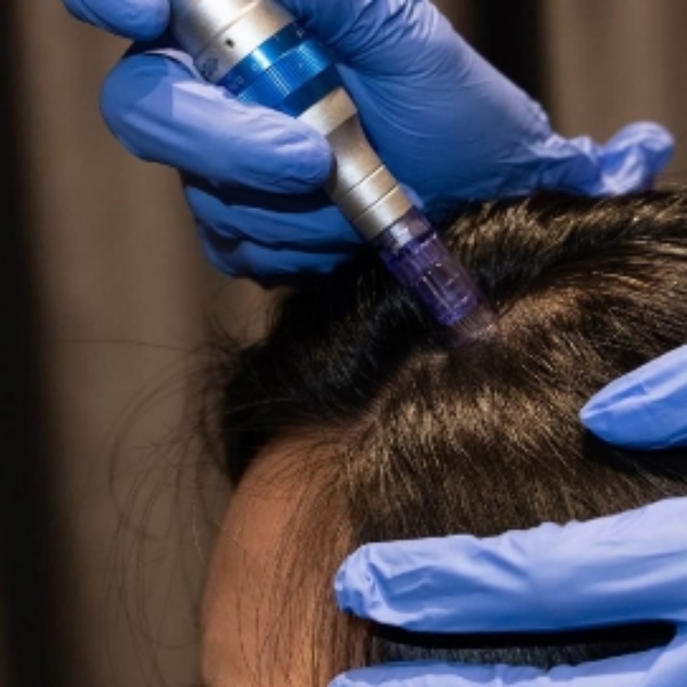 Hair Restoration Treatment at Ultimate Health Spa in Leesburg, FL