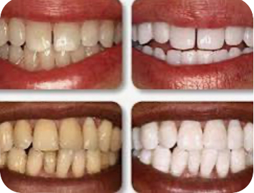Advance Teeth Whitening