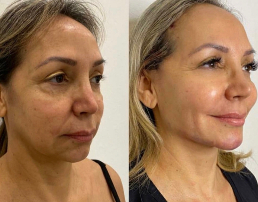 Botox