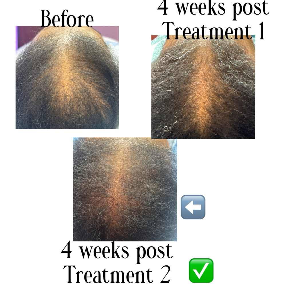10 Hair Loss Stem Cell Therapy at Houston Skin Treatment in Houston, TX