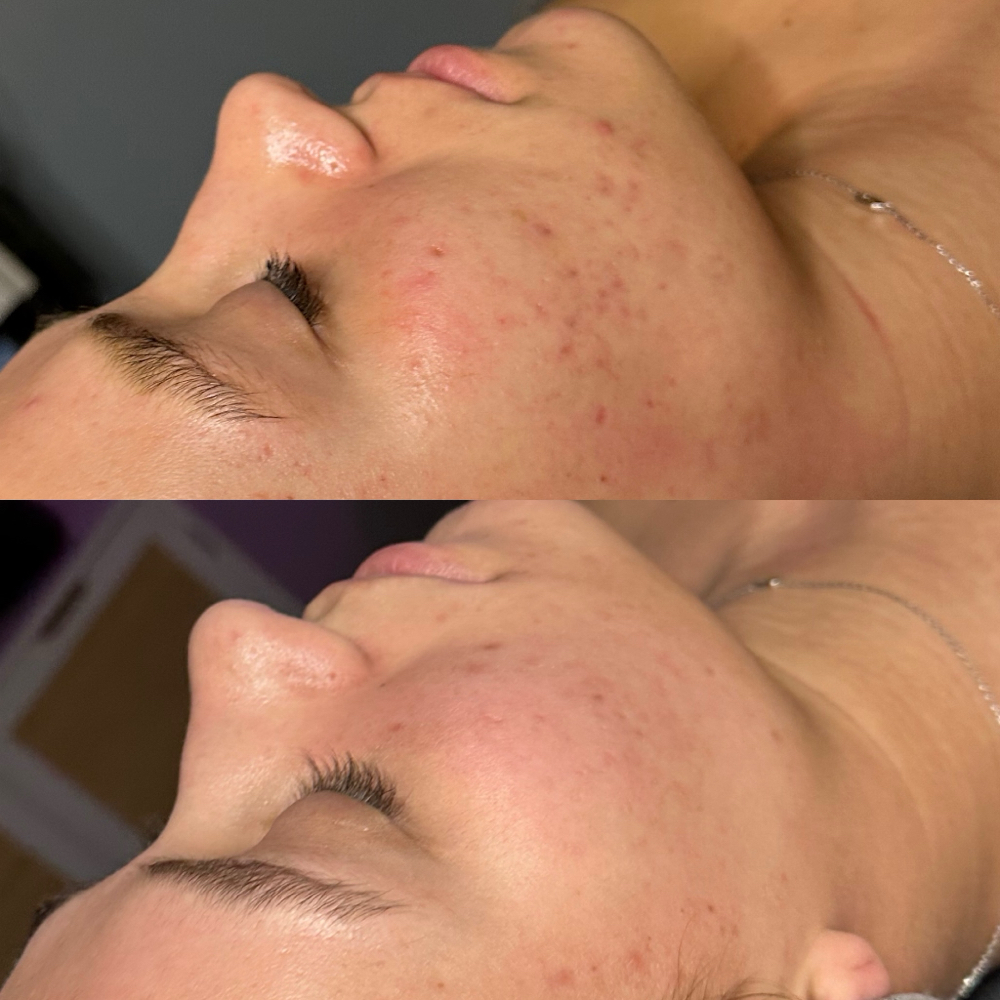 Custom Facial Peel