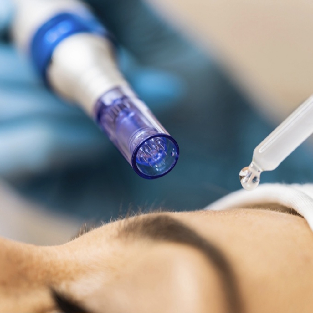 Microneedling Avanzado at Shandel Beauty Lab in Teaneck, NJ
