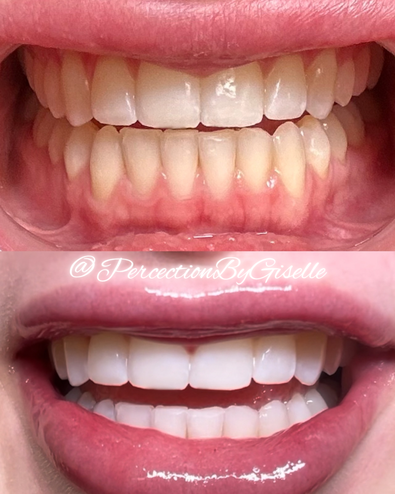 Teeth Whitening 60 Minute Session